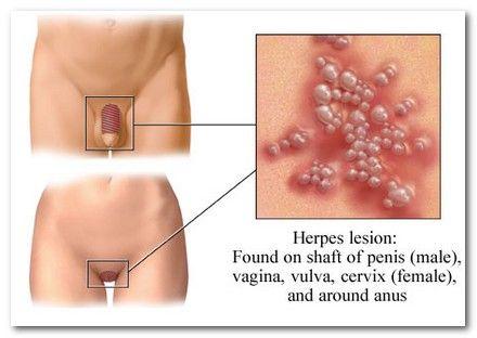 genital herpes eradication