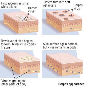 stages of herpes