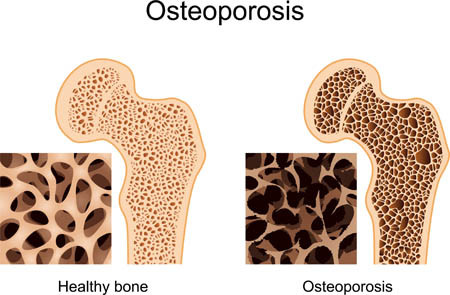 living with osteoporosis