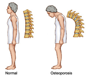 osteoporosis treatments