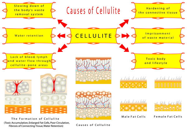 what causes cellulite formation