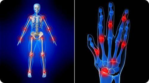 arthritis home remedies for legs