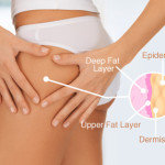 cellulite formation