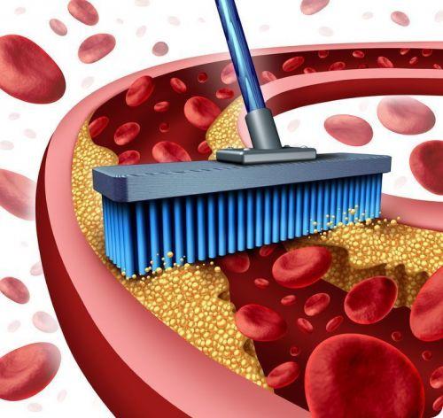 how to remove plaque from arteries without surgery